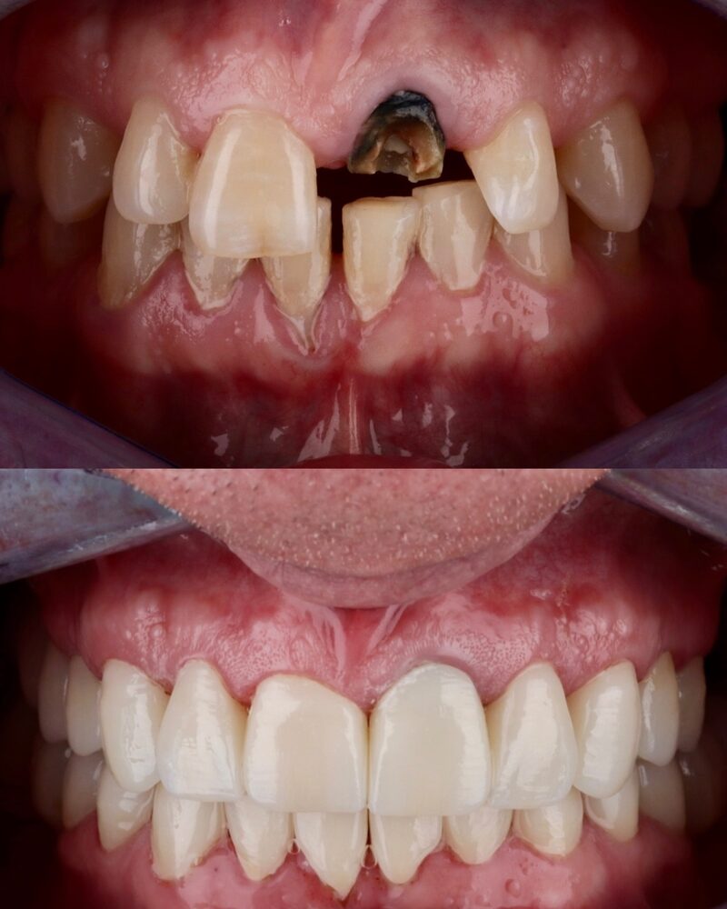 Before and after front teeth restoration with crowns at Tooth Implant Co. in Los Algodones, Mexico