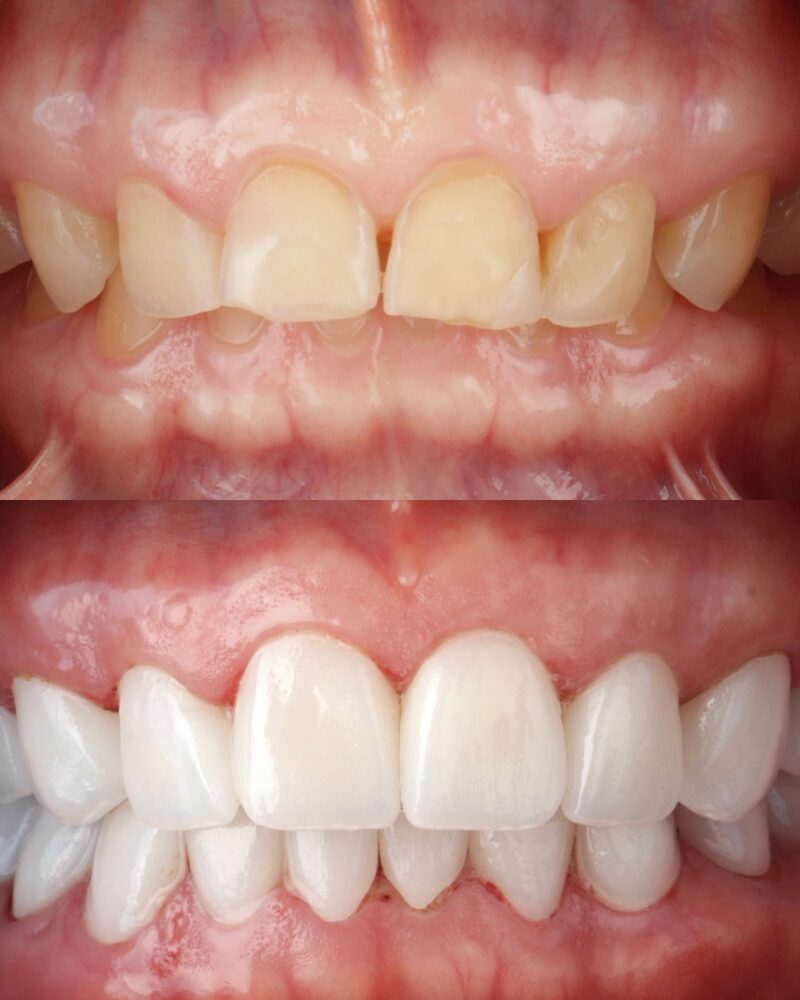 Before and after full smile makeover with porcelain veneers and crowns in Los Algodones, Mexico