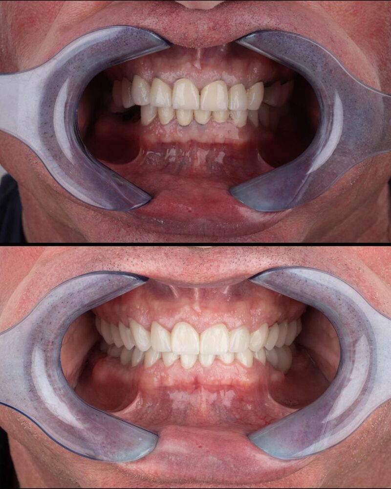 Before and after full smile restoration of upper and lower teeth at Tooth Implant Co. in Los Algodones, Mexico