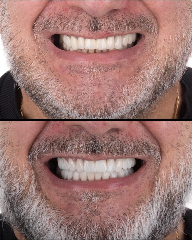 Before and after bright smile makeover at Tooth Implant Co. in Los Algodones, Mexico