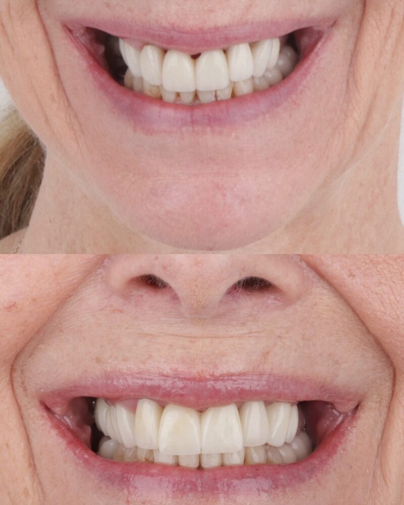 Before and after smile refresh with new crowns at Tooth Implant Co. in Los Algodones, Mexico