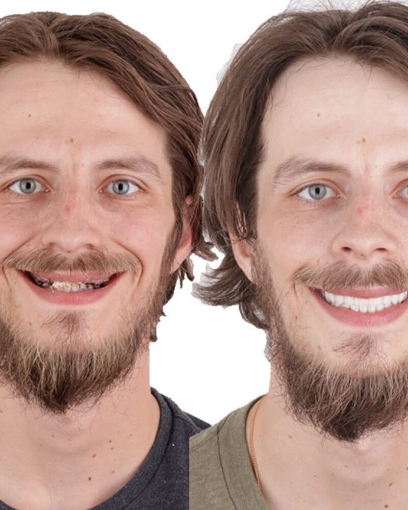 Before and after complete smile transformation at Tooth Implant Co. in Los Algodones, Mexico